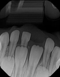 X-ray of primary teeth starting to erupt in a child.