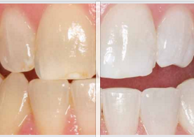 Before & After Whitening Picture