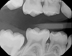 X-ray of first molars ready to erupt on a child.