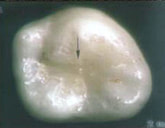 Picture of composite filling